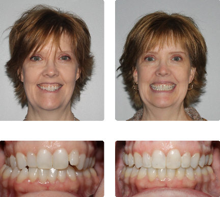 hopkinton braces
