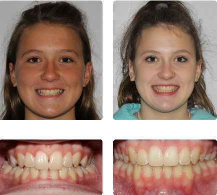 hopkinton braces
