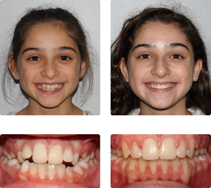 hopkinton braces