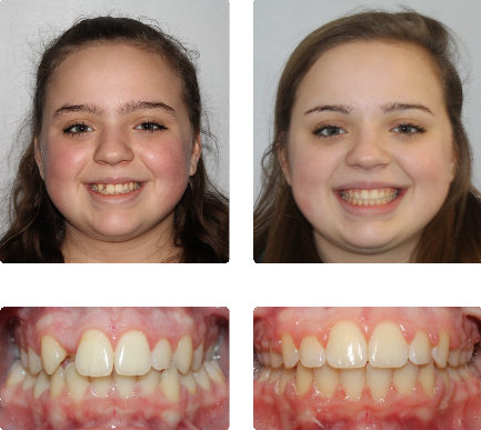 hopkinton braces