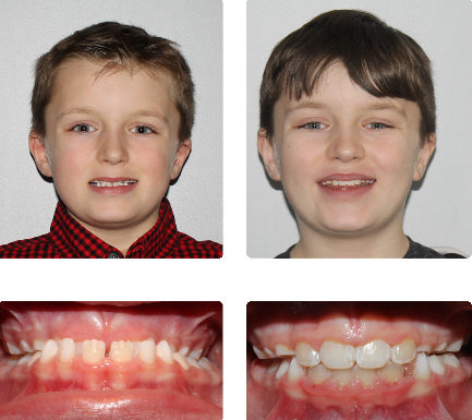 hopkinton braces
