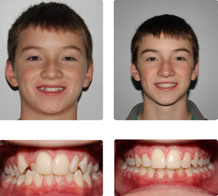 hopkinton braces