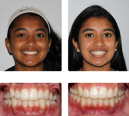 hopkinton braces