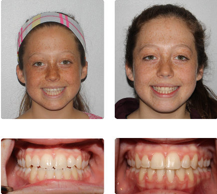 hopkinton braces