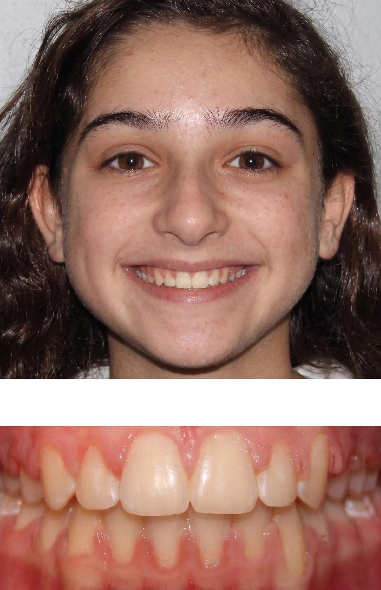 After Orthodontic Treatment